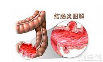 溃疡性结肠炎导致便血怎么办