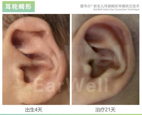 人们认为耳轮畸形能够自我恢复,但通常不是这样