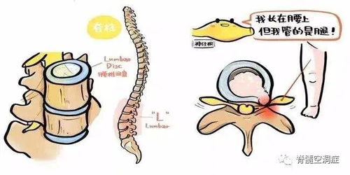 脊髓内形成的空洞,会损坏人体的神经系统,导致症状接踵而来