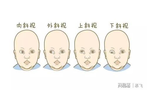 斜视是不是天生的 斜视有哪些危害