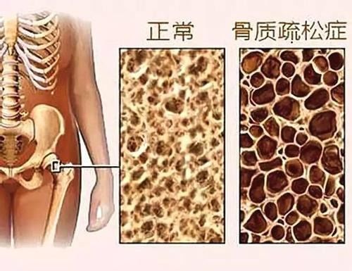 骨质疏松 给错了是痛 给对了才是爱