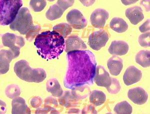 粒细胞减少会引起脓毒血症吗