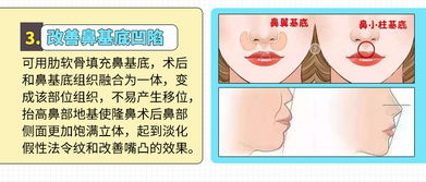 自体肋软骨隆鼻 肋软骨隆鼻 半肋隆鼻 打造妈生鼻天生材料 改善疑难杂症的鼻形 悦美整形 