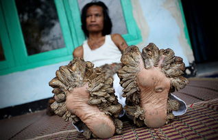印尼树人有望恢复健康 