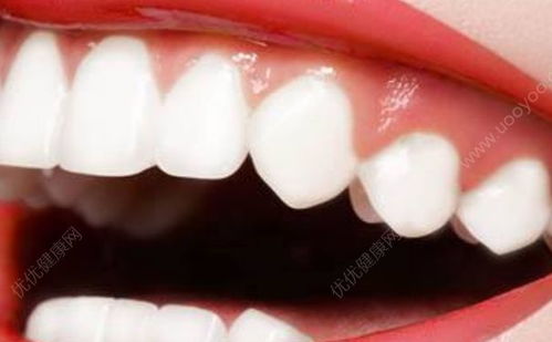牙龈出血的原因(牙龈出血是怎么回事啊)