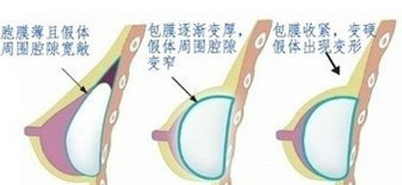 安全的方式现在可以规避包膜挛缩问题了吗