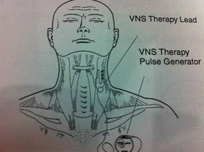 药物难治性癫痫无创手术 迷走神经刺激术