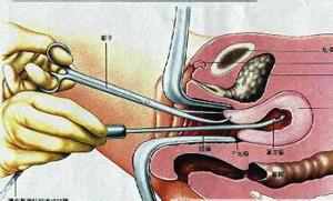 子宫内膜厚刮宫图片
