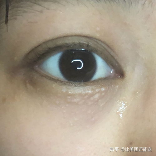 女人右眼皮上有红痣代表什么