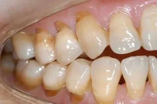 口腔咨询师补牙患者话术和接诊技巧
