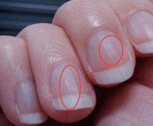 指甲竖纹肝癌图片 