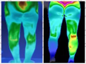 红外热成像诊疗技术有哪些