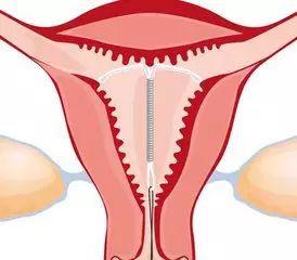 卵巢炎 常被忽视的妇科炎症,会影响怀孕吗