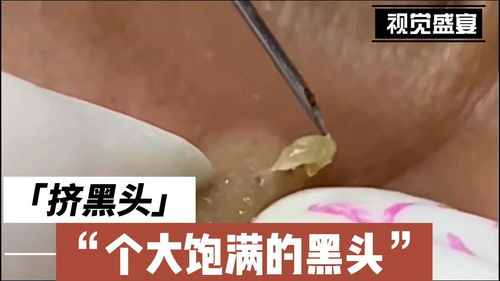 挤黑头 鼻子上的大黑头 