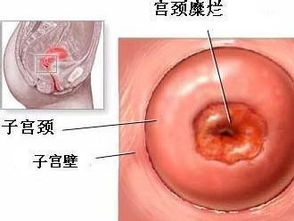 做宫颈糜烂手术后月经时间变长且经量不规律是怎么回事