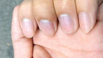 毛毛提醒 你的指甲上有竖纹吗 这是大病预兆