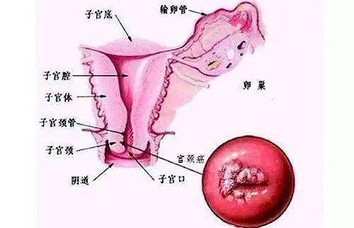 宫颈内口和外口图片