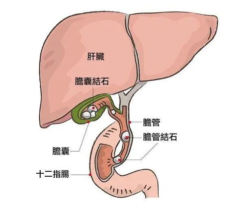 三小时致命的胆结石,千万别小看它