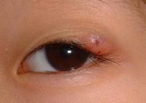 眼科医生教您如何预防这些常见眼疾