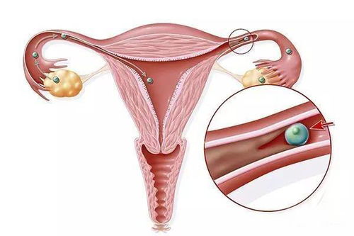 输卵管性不孕 什么是输卵管性不孕