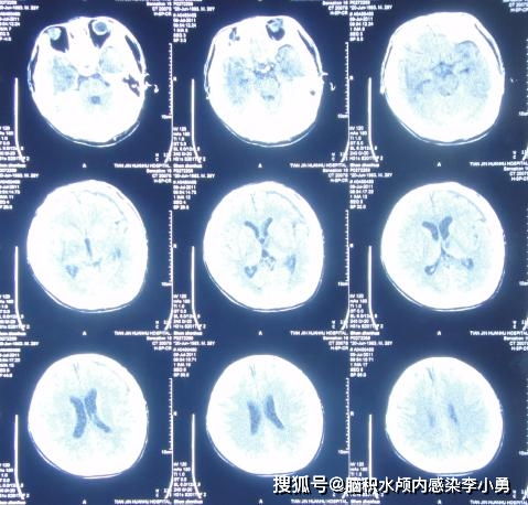 车祸致15个月 植物人 ,经脑脊液科 促醒 治疗出院3年后基本恢复自理