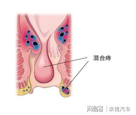 不花钱也可以治痔疮 老中医告诉你 无花果也能有效的消除肉球