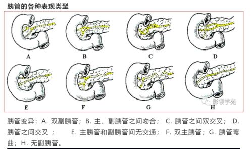 主胰管副胰管示意图 搜狗图片搜索