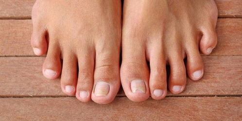为什么有的人,小脚趾会有两片指甲,脚趾甲出现7种情况,需重视