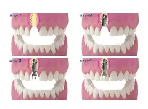要去做种植牙,要满足什么条件呢