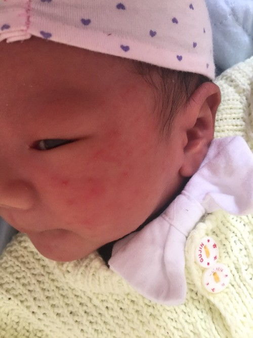 我们家宝宝出生26天了 最近几天脸上长了好多红痘痘 有的痘痘还有白 
