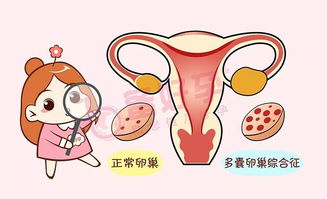 原创得了多囊卵巢综合症又着急生宝宝，怎么办？