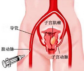 25岁没男友未婚未孕得了很大子宫肌瘤怎么办