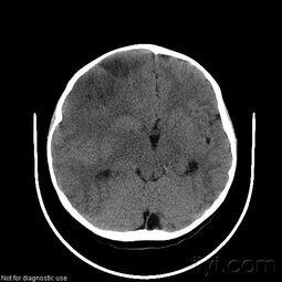 20091121小儿头颅CT,畸形 庆祝爱爱医新生,来讨论吧 医学影像学讨论版 爱爱医医学论坛 
