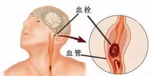 养生 五大冬季疾病高发因素要注意