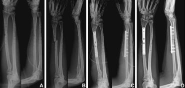 Arch Orthop Trauma Sur 前臂骨干骨折愈合后无需常规拆除钢板