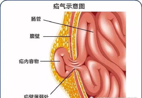 疝气术后有硬块图片 搜狗图片搜索