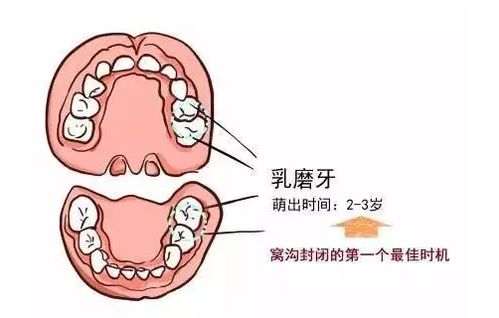 36.6元超低价抢500元 同步齿科 儿童实用护齿产品三选一套餐 全口涂氟 窝沟封闭1次 1颗 拔乳牙1次 1颗 ,深圳40店通用