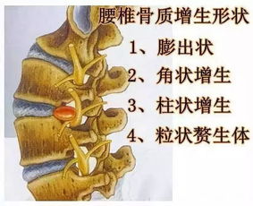中国腰椎病患者已突破2亿,它和骨质增生有区别吗