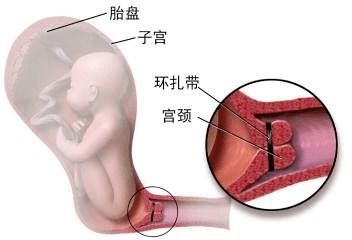 怀孕26周,宫颈机能不全流产了