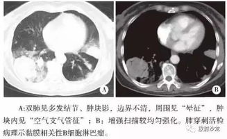 累及肺 支气管的它,长什么样 