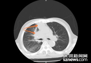 CT热成像：一种新型肺癌筛查方式？