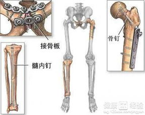 骨折了怎么办