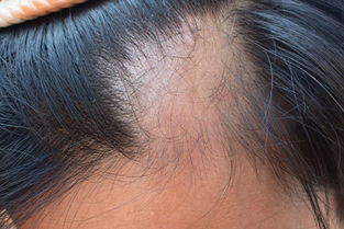 斑秃是什么病的前兆 “鬼剃头”是什么？该怎么解决？ 
