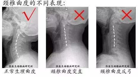 颈椎不好,只需一个小方法,就解决了