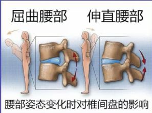 今生让腰椎间盘突出症与你无缘