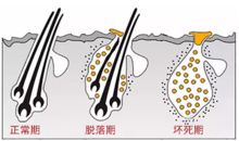 关于脱发治疗,这几个毛囊问题你必须要知道哟