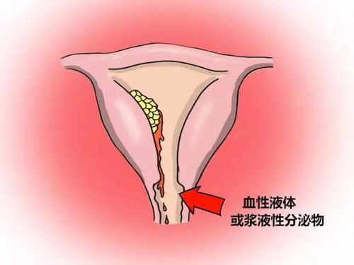 子宫内膜癌你了解多少