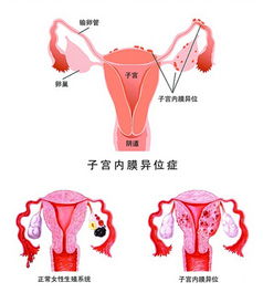 西安生殖保健院科普：腹壁子宫内膜异位症，对怀孕有影响吗?