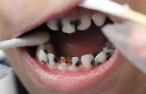3岁宝宝满口小黑牙,家长注意孩子牙齿健康,看看这几条建议