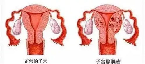 子宫肌瘤专挑3种女人下手 越早艾灸,越早恢复,远离折磨